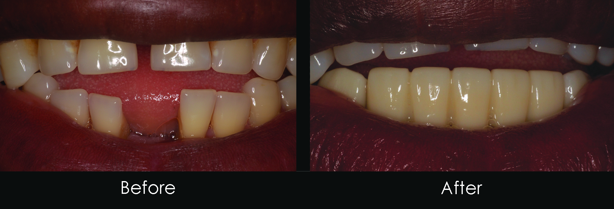 Before and After dental Bridge