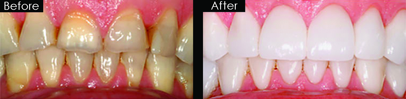 Before and After Crowns