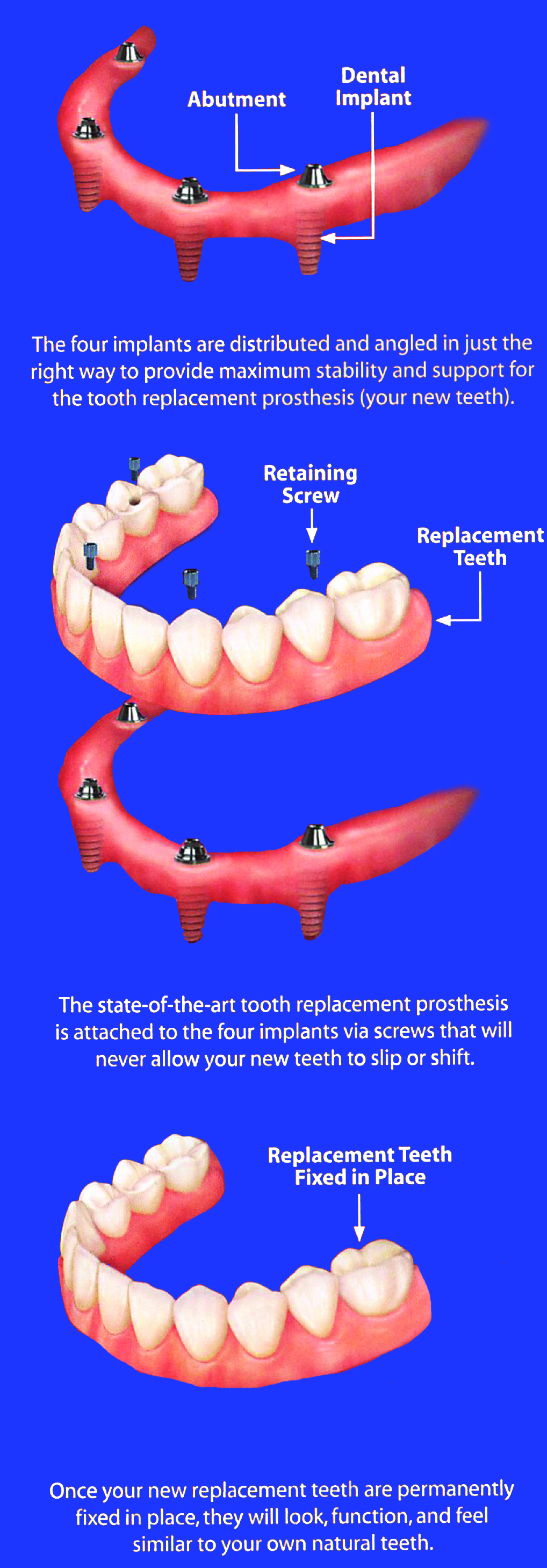 infographic about dental implant supported denture, dental implants Royal Palm Beach, FL