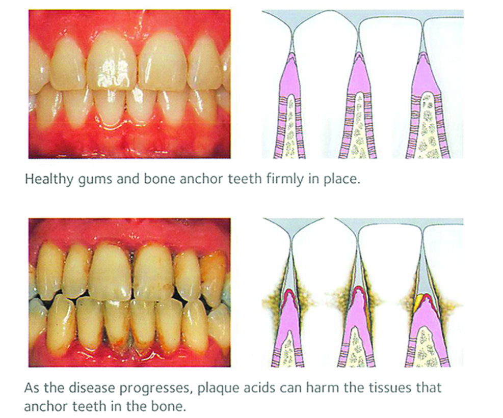 Gum Disease and teeth become loose 