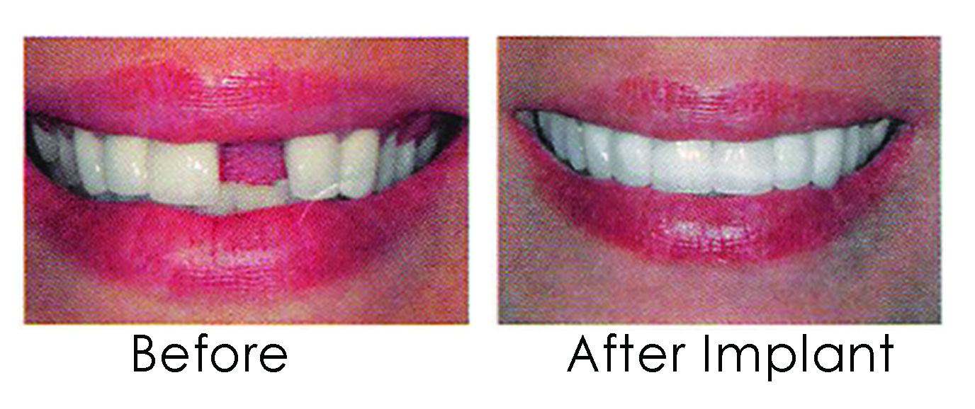 Before and After Dental Impant Family Dentist of Palm Beach | Palm Beach FL