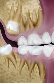wisdom teeth Family Dentist of Palm Beach | Palm Beach FL