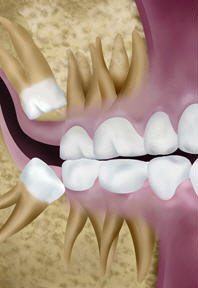 illustration of teeth and impacted wisdom tooth, need wisdom teeth extraction Royal Palm Beach, FL